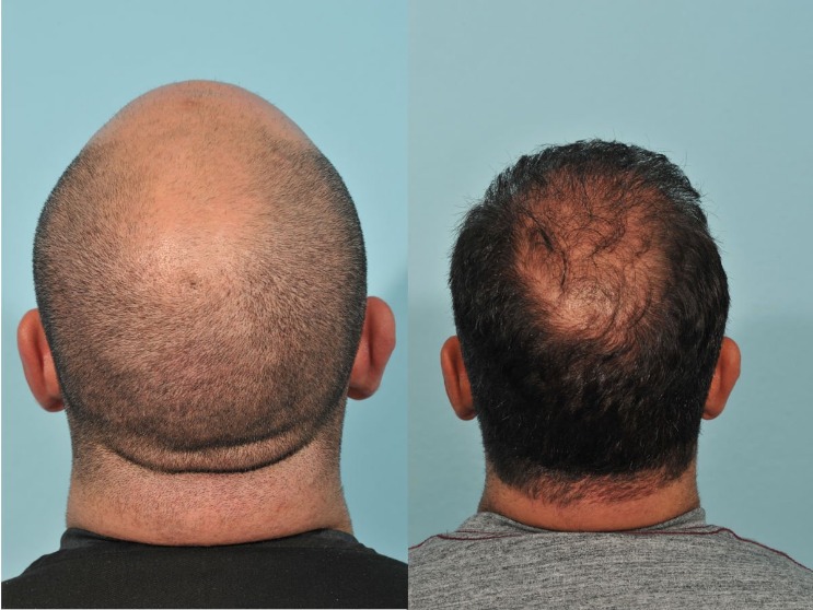 How Much Does a Hair Transplant Cost in The Philippines? Prices in 2023