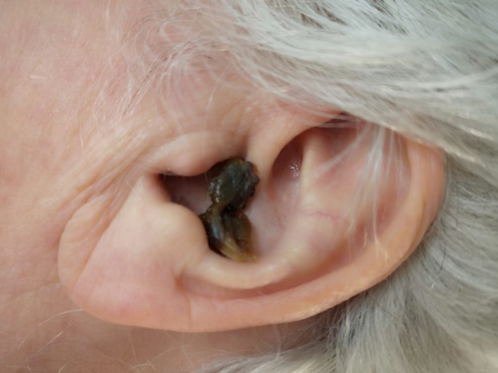 Just How To Tidy Toddler Ears And Earwax